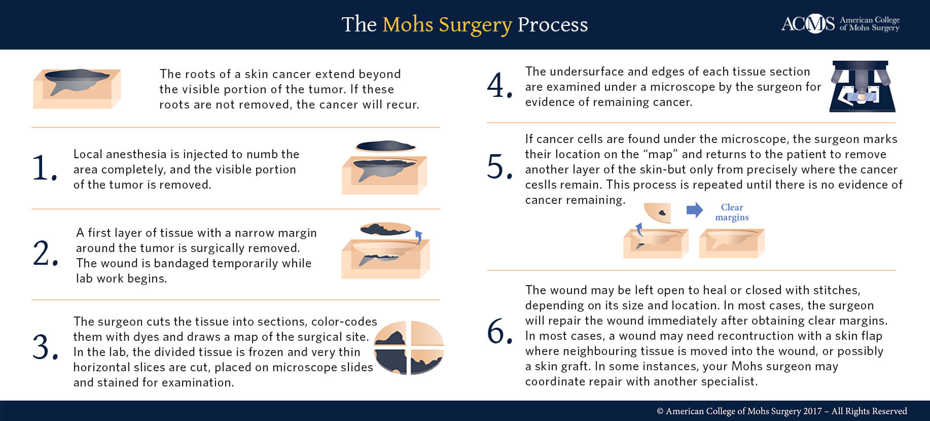 Mohs Surgery Process