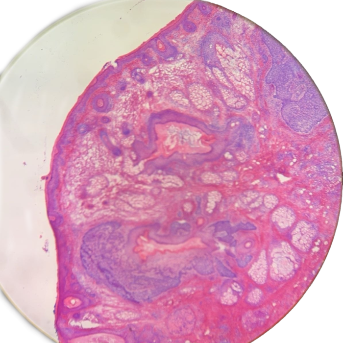 Nodular Basal Cell Carcinoma on Nasal Ala in San Antonio processed by MohsPros.